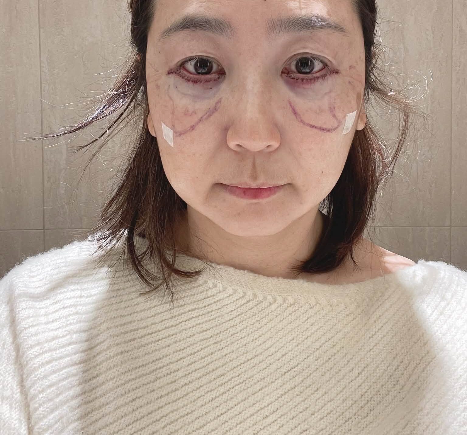 關於眼袋手術的個人紀錄:一段關於選擇、修復與生活好氣色的紀錄 @蜜絲米的散步生活 @蜜絲米的散步生活