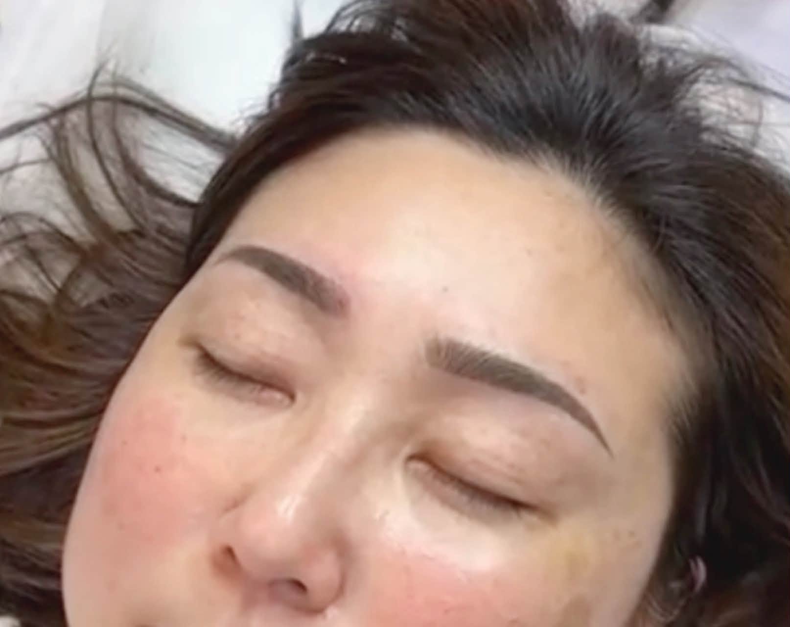 關於眼袋手術的個人紀錄:一段關於選擇、修復與生活好氣色的紀錄 @蜜絲米的散步生活 @蜜絲米的散步生活