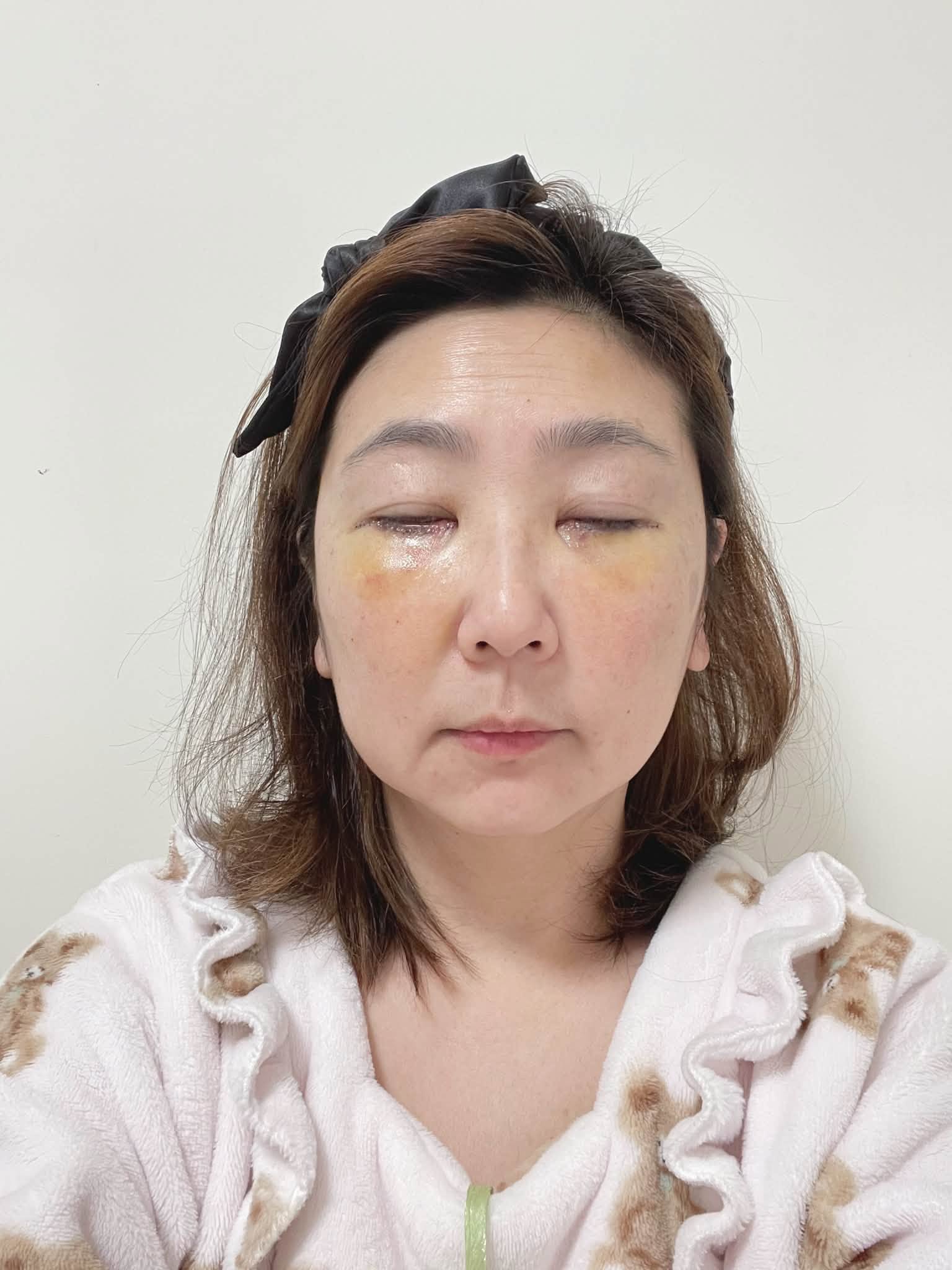 關於眼袋手術的個人紀錄:一段關於選擇、修復與生活好氣色的紀錄 @蜜絲米的散步生活 @蜜絲米的散步生活