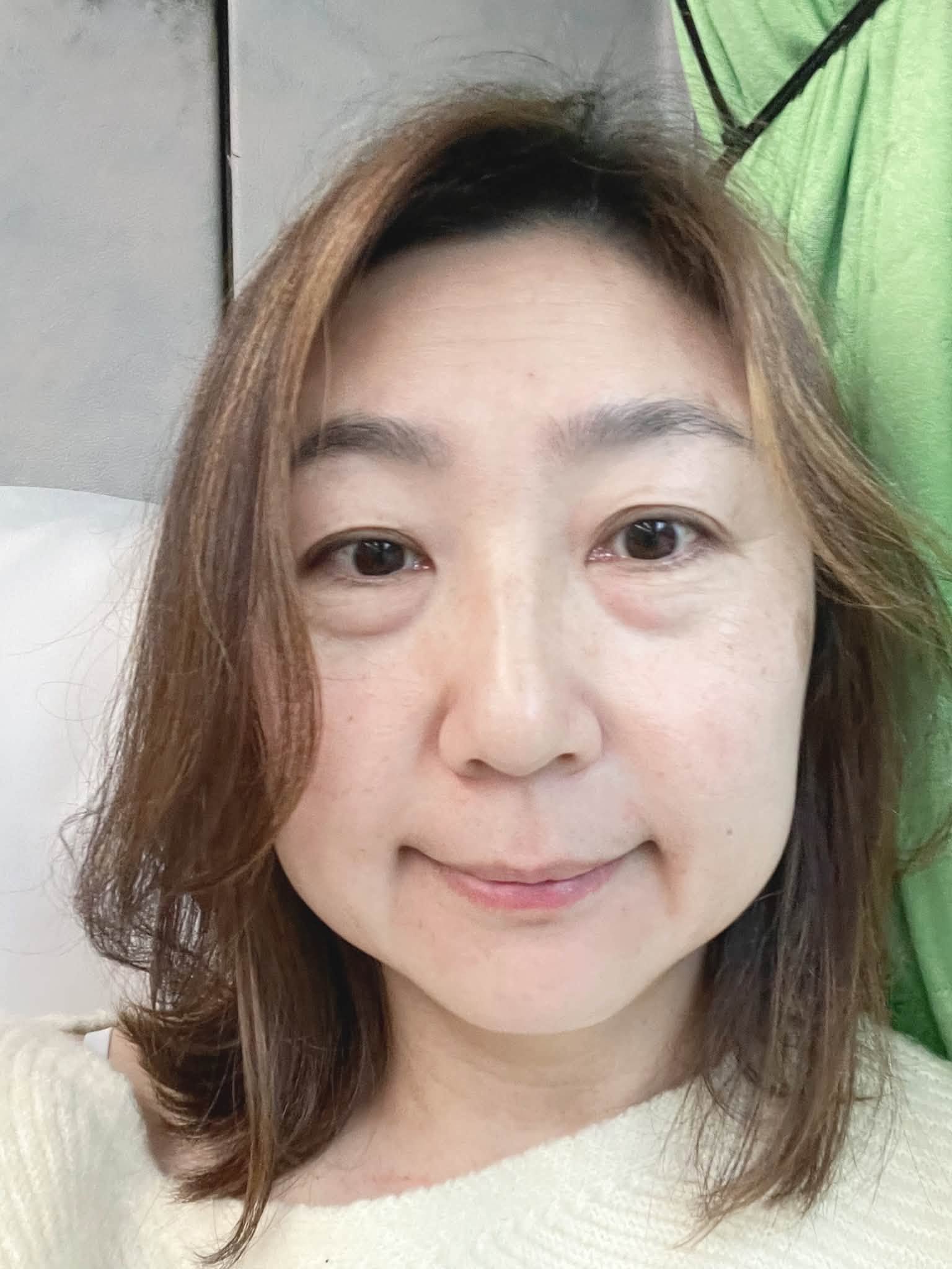 關於眼袋手術的個人紀錄:一段關於選擇、修復與生活好氣色的紀錄 @蜜絲米的散步生活 @蜜絲米的散步生活